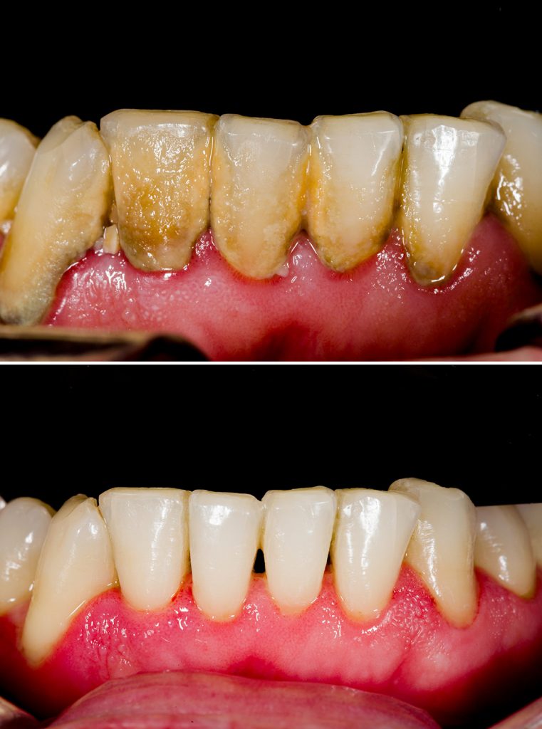 calculus teeth before and after